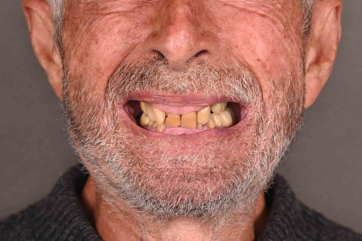 Pacient Clinica Dr. Alin Odor - Rezultat Implantologie